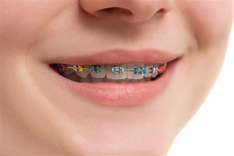 ¿Puede un dentista eliminar la placa con ortodoncia?