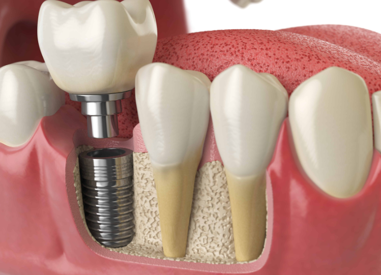 ¿Cuánto cuestan los implantes dentales?