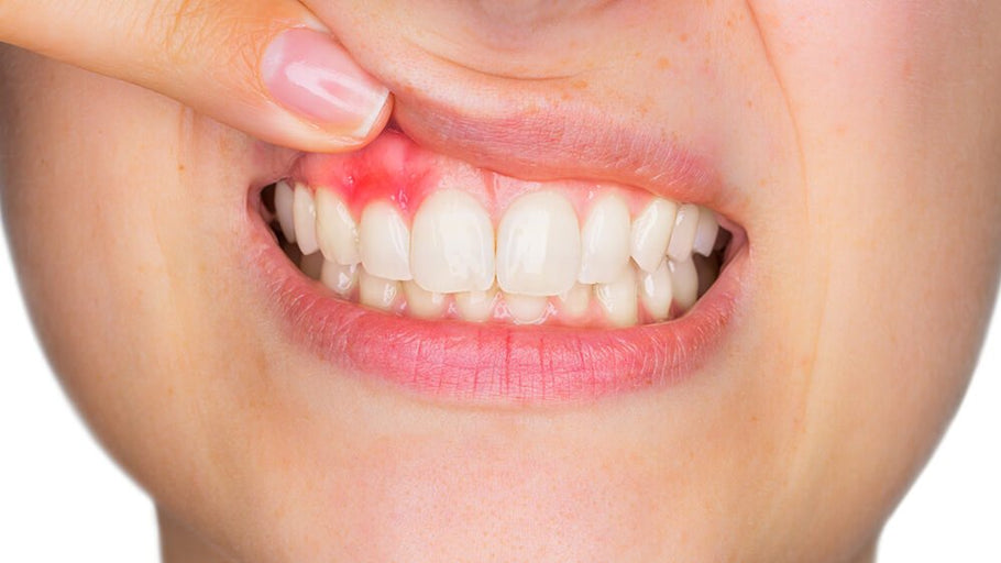 ¿Es contagiosa la gingivitis? Hechos científicos sobre la transmisión de enfermedades de las encías