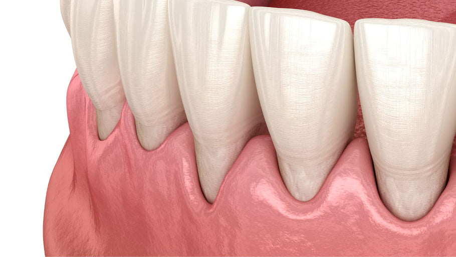 ¿Son buenos los cepillos de dientes sónicos para las encías retraídas?