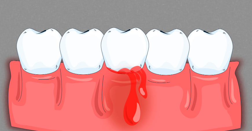 ¿Por qué sangran mis encías cuando uso hilo dental?