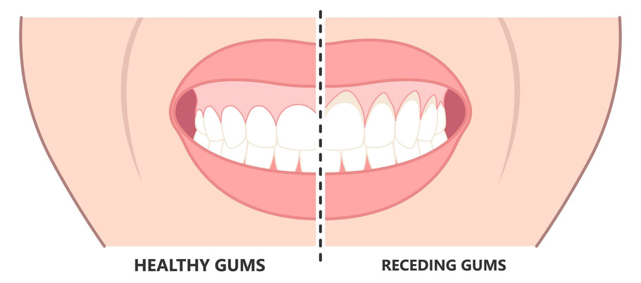 ¿Hasta dónde pueden retroceder las encías antes de que se caigan los dientes?