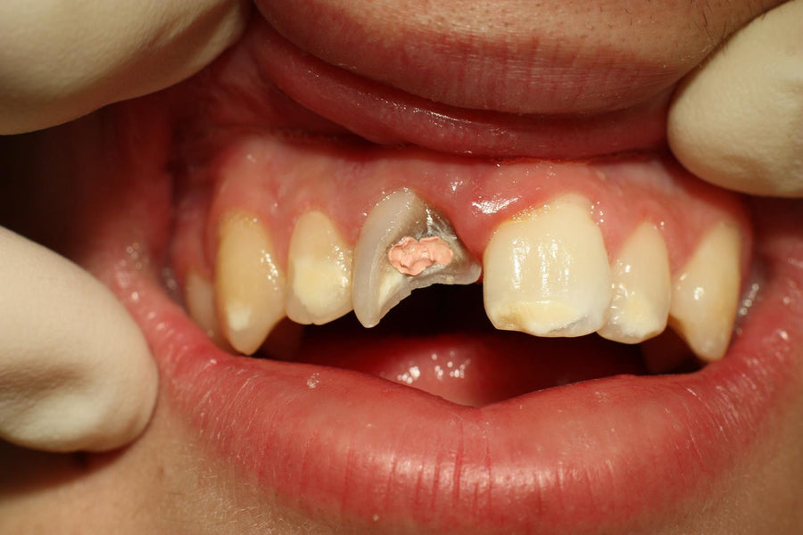 ¿Se puede you hacerse una endodoncia con un diente astillado?