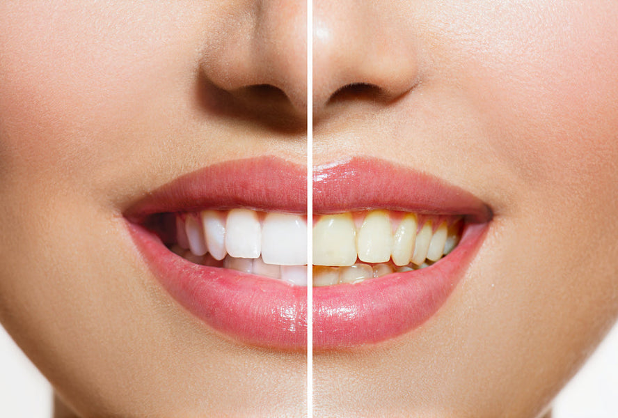 ¿Por qué mis dientes están amarillos si los cepillo todos los días?