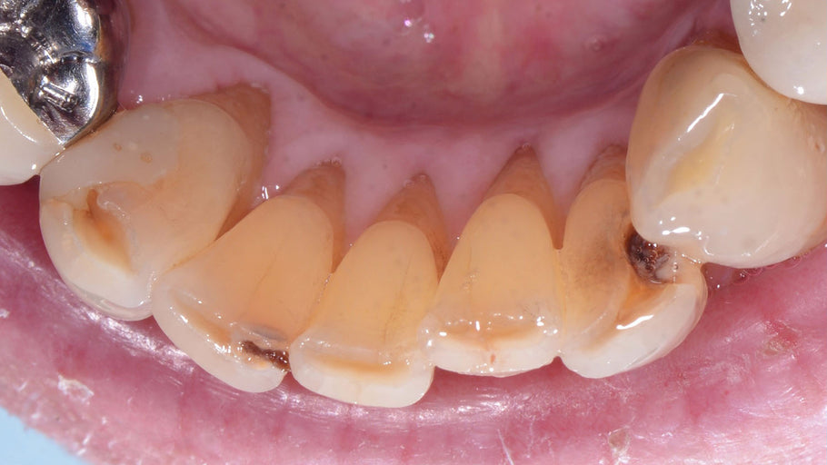 ¿Puede una raíz dental expuesta causar visión doble?