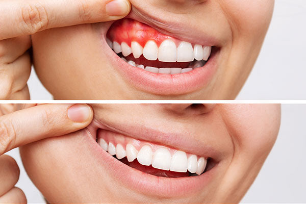Cómo curar la enfermedad de las encías sin un dentista: Remedios caseros efectivos y consejos de prevención