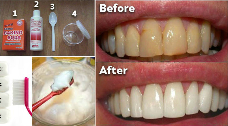 Cómo eliminar el sarro de los dientes sin un dentista