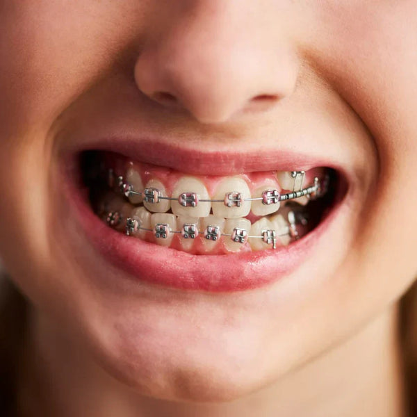 ¿Cómo usar hilo dental con brackets? Todo lo que you necesitas saber