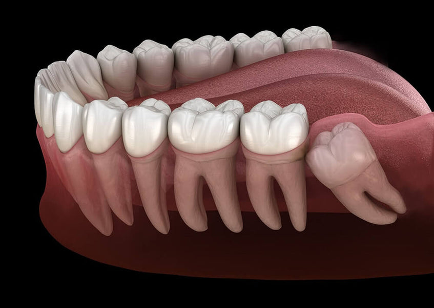 ¿Pueden volver a crecer las muelas del juicio? Mitos, hechos y perspectivas dentales